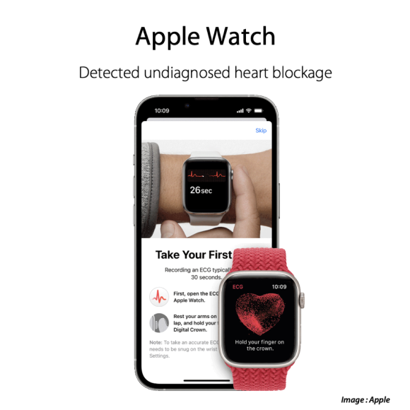 Apple Watchの心電図アプリで房室ブロック判明〜ペースメーカーを装着し退院